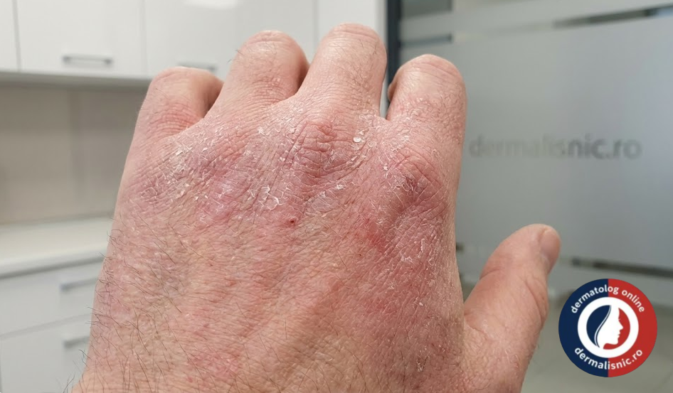 Eczema mâinilor - Definiție