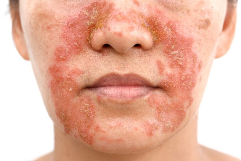 Dermatita Seboreică La Adult