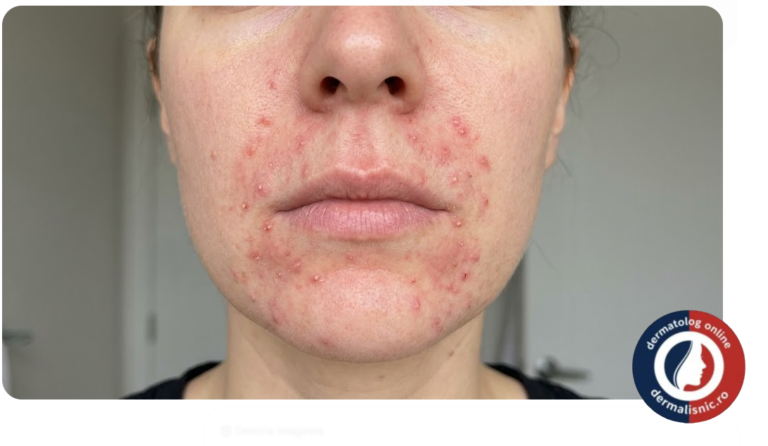 Fotografie de prim-plan a unei femei cu dermatită periorală severă în jurul gurii și nasului, prezentând roșeață, papule și pustule.