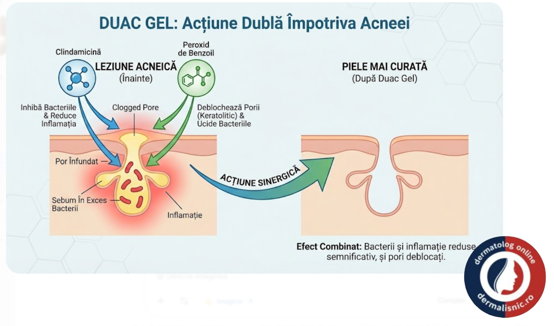 Diagramă infografică ce ilustrează acțiunea sinergică a clindamicinei și peroxidului de benzoil asupra acneei, țintind bacterii, inflamația și porii înfundați.