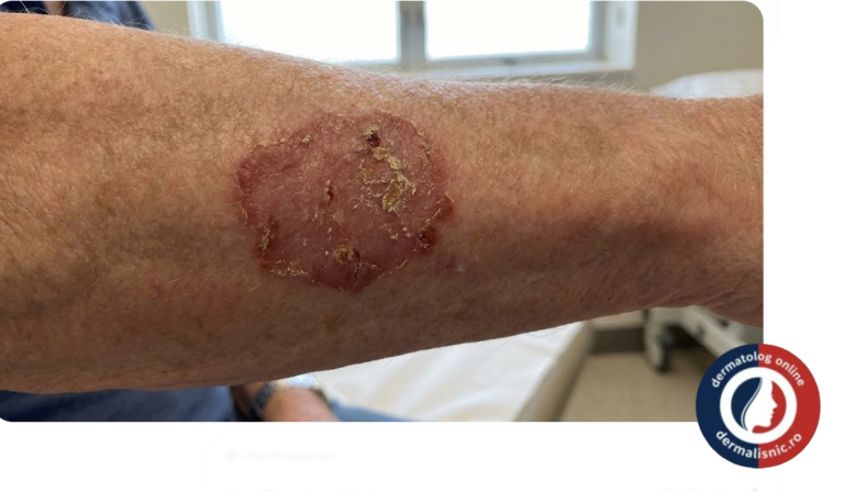 Ilustrație medicală a unei secțiuni transversale de piele, evidențiind celule carcinomatoase atipice în toată grosimea epidermului, strict limitate de membrana bazală, reprezentând Carcinomul Spinocelular in Situ.