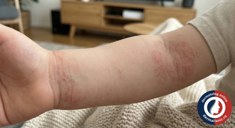 dermatita atopica copil, eczema piele uscata, ingrijire dermatita, copil nordica eczema