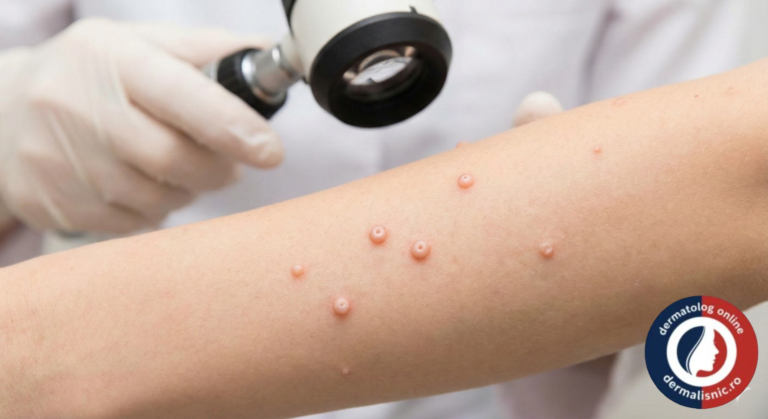 Molluscum Contagiosum, piele copil, infecție virală, dermatologie