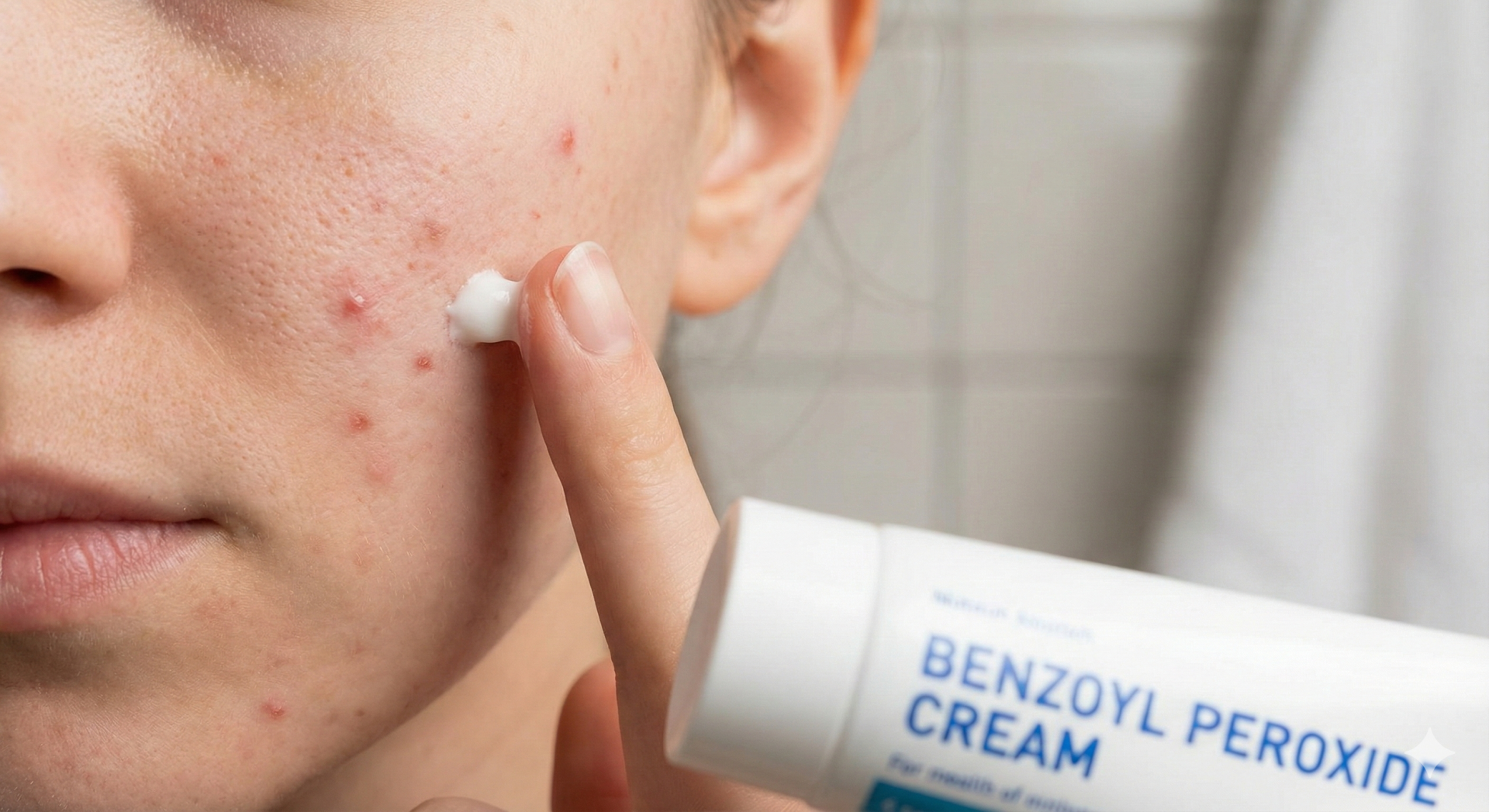 Imagine macro cu aplicarea corectă a peroxidului de benzoil pe pielea cu acnee, evidențiind rutina de tratament topic recomandată de dermatologul online Dermalisnic.