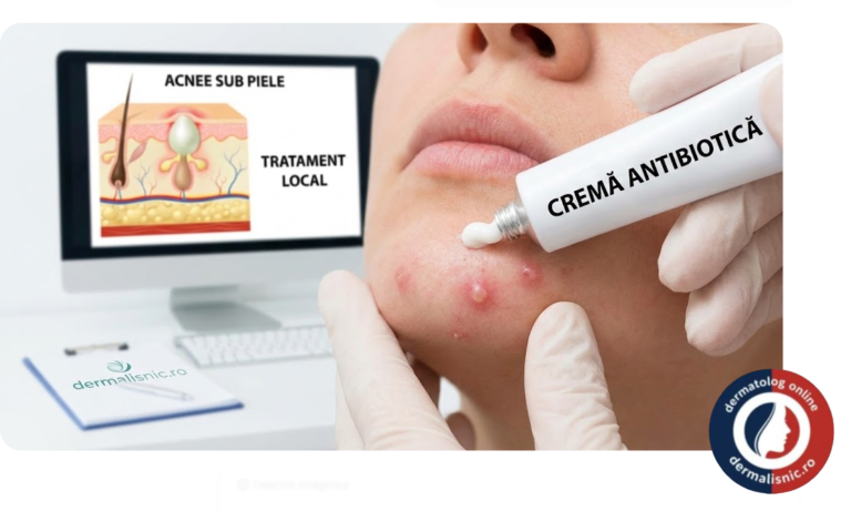 Cremă cu antibiotic pentru coșuri sub piele - Imagine Principală