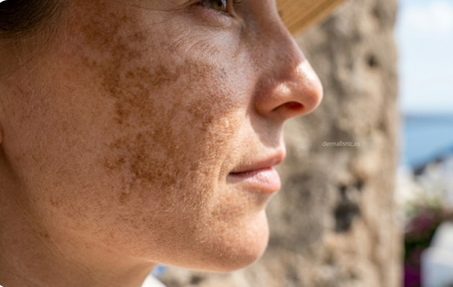 Cum protejăm tenul cu melasmă în sezonul estival? — ⠿de ce apare sau se agravează melasma în sezonul estival? | dermalisnic.ro