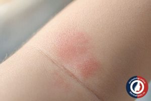 Dermatită sau Eczemă