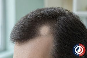 Pată rotundă de alopecia areata pe scalp - simptom principal al bolii
