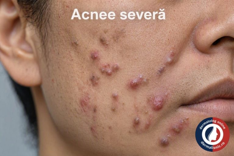 Consult dermatologic pentru acnee nodulară la clinica
